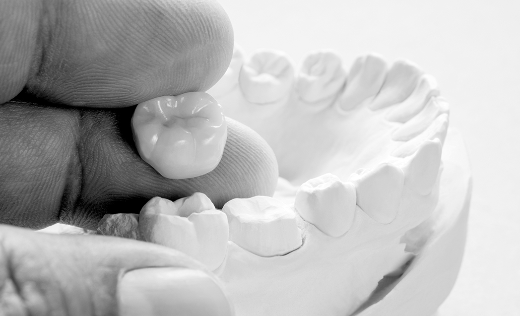 Une couronne dentaire près d'un moule de la dentition d'un patient.