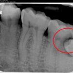 A radiography of a wisdom tooth growing in a problematic way.